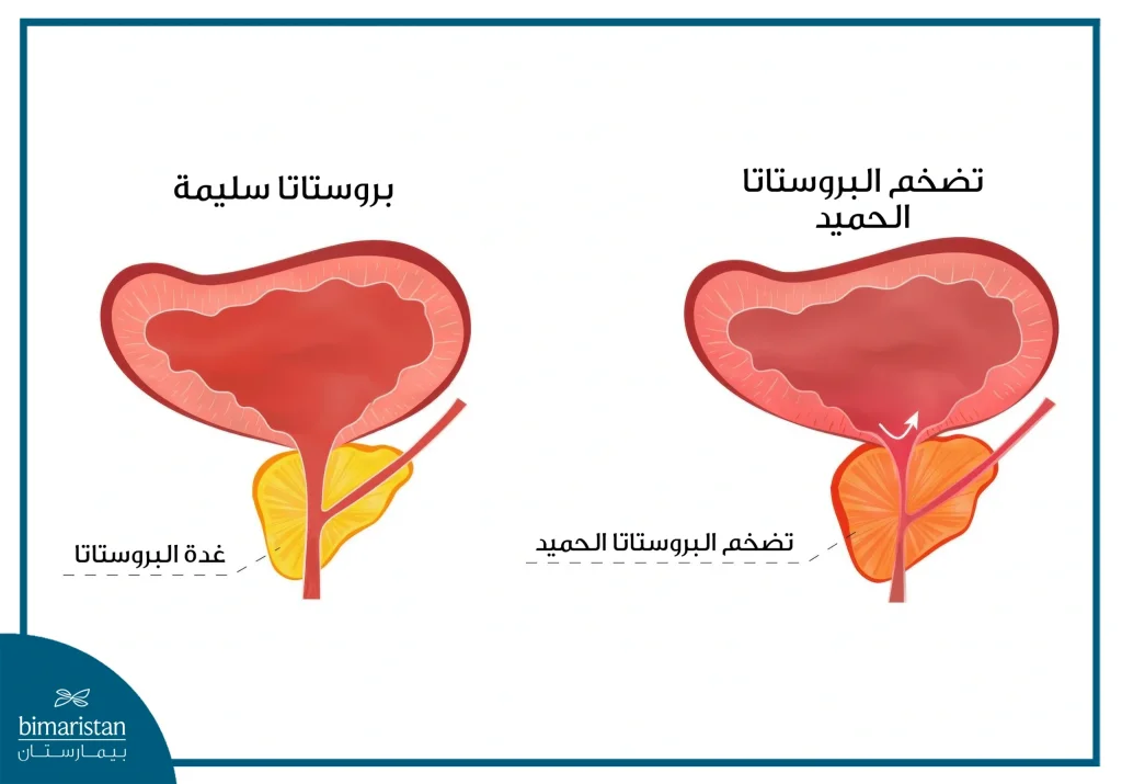 سلس البول: أنواعه وأسبابه وعلاجه 2 تضخم البروستاتا الحميد
