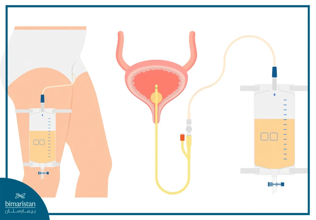 Urinary Incontinence: Types, Causes And Treatment 3 Catheters