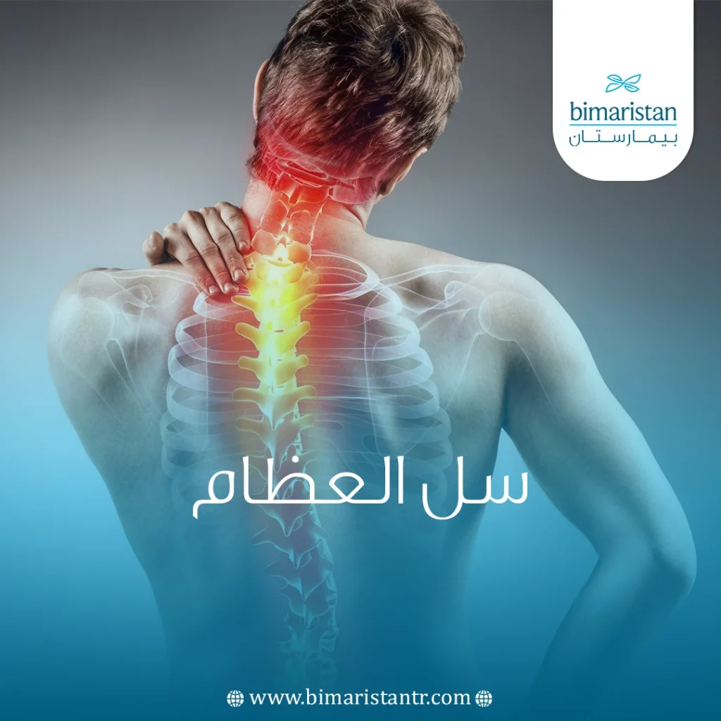 كل ما يتعلق حول مرض السل في العظام - بيمارستان