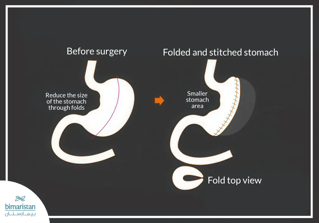 Gastric Plication Surgery: A Game-Changing Approach Towards Obesity Treatment 3 The Surgical Process Behind Gastric Plication