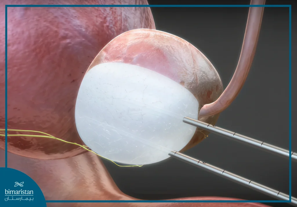 Interventional Radiology Cancer Treatments 2 Cryotherapy Is An Interventional Radiology Cancer Treatments In Turkey That Destroys Cancer Cells By Freezing Them.