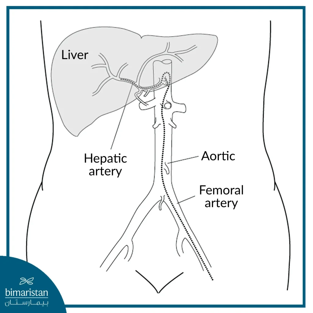 Interventional Radiology Cancer Treatments 3 Treatment Of Liver Cancer Using Chemotherapy