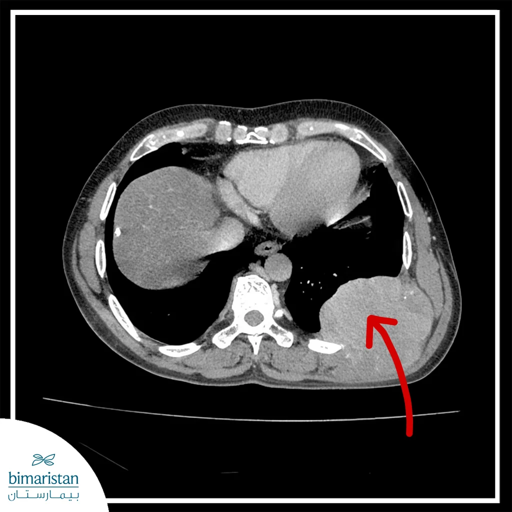 Chest Wall Tumor Treatment: Types, Resection &Amp; Recovery Options 3 Ct Scan Showing A Palpable Tumor In The Left Chest Wall, Used To Diagnose And Plan Chest Wall Tumor Treatment.