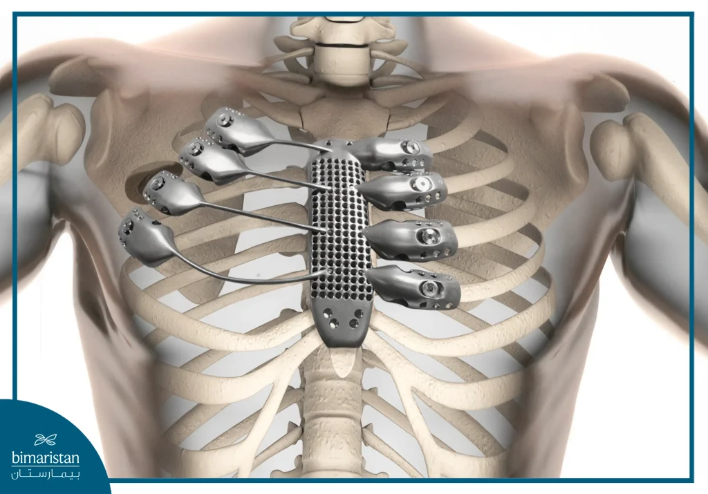 Chest Wall Tumor Treatment: Types, Resection &Amp; Recovery Options 5 Prosthetic Stents After Resection Of Chest Wall Tumors