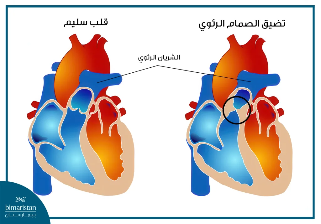 علاج تشوهات القلب عند الأطفال حديثي الولادة: الدليل الكامل من التشخيص إلى التعافي 4 تضيق الصمام الرئوي أحد تشوهات القلب الخلقية التي تظهر عند المواليد
