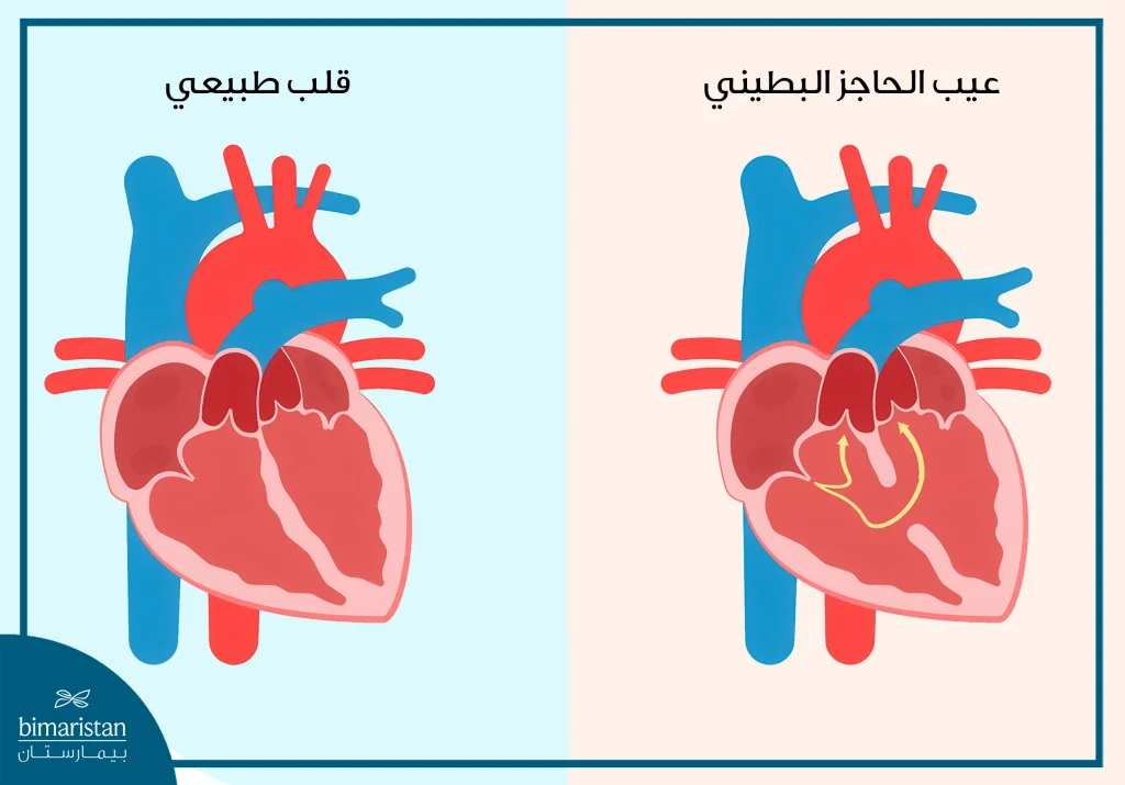 علاج تشوهات القلب عند الأطفال حديثي الولادة: الدليل الكامل من التشخيص إلى التعافي 3 عيب الحاجز البطيني أحد تشوهات القلب الخلقية التي تظهر عند المواليد
