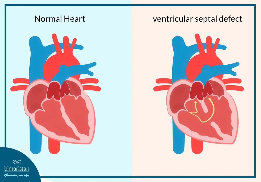 Newborn Congenital Heart Defect Treatment: Complete Guide &Amp; Recovery 3 علاج تشوهات القلب عند الأطفال حديثي الولادة 2 Eng