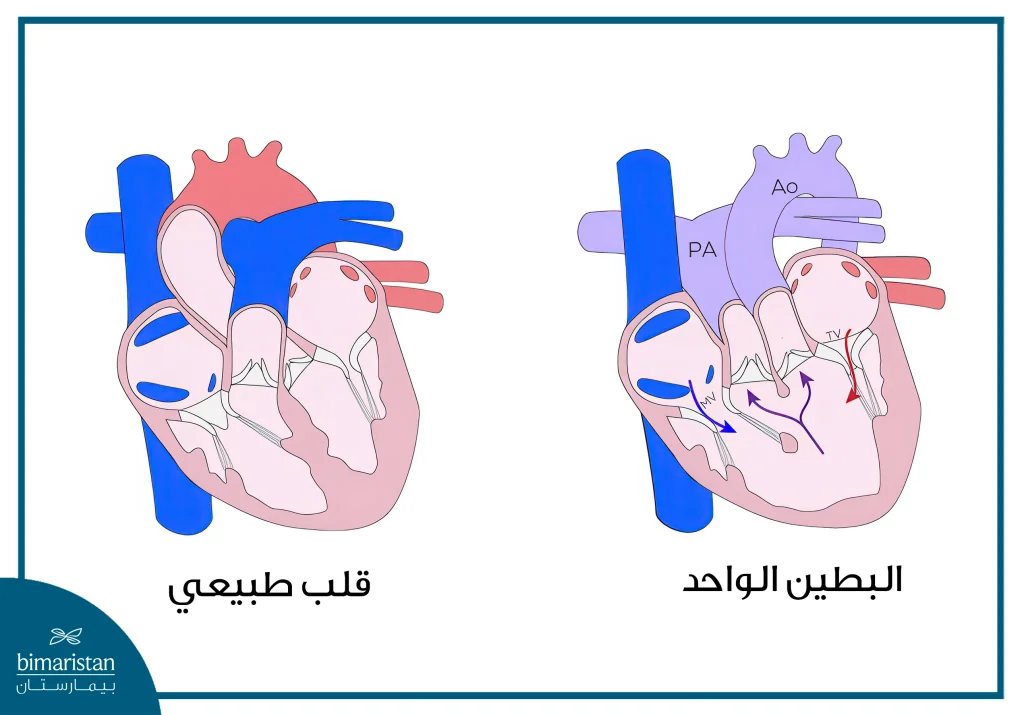 علاج تشوهات القلب عند الأطفال حديثي الولادة: الدليل الكامل من التشخيص إلى التعافي 5 البطين الواحد أحد تشوهات القلب الخلقية التي تظهر عند المواليد
