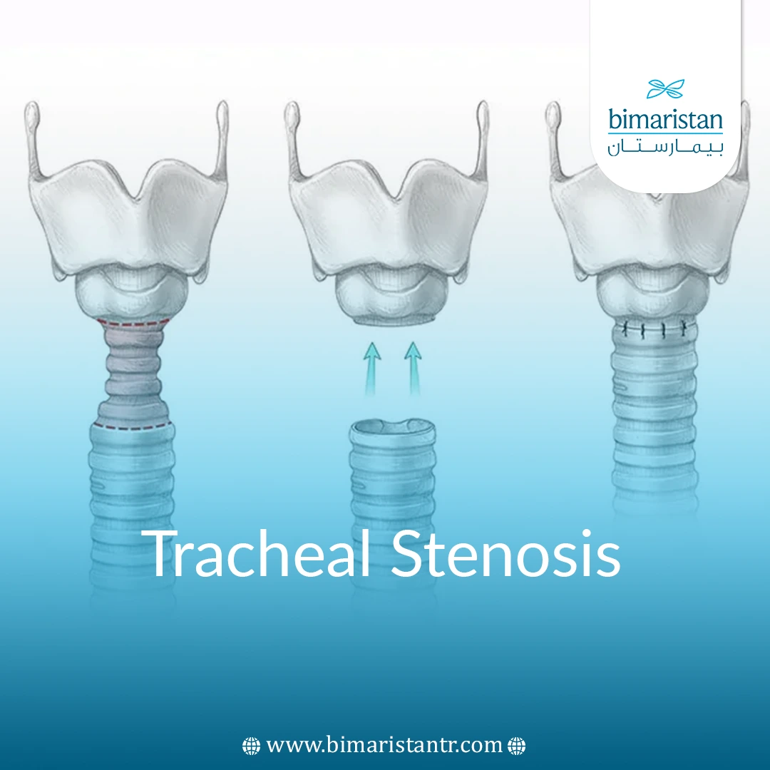 Tracheal Stenosis: Causes, Diagnosis &Amp;Amp; Treatment In Turkey