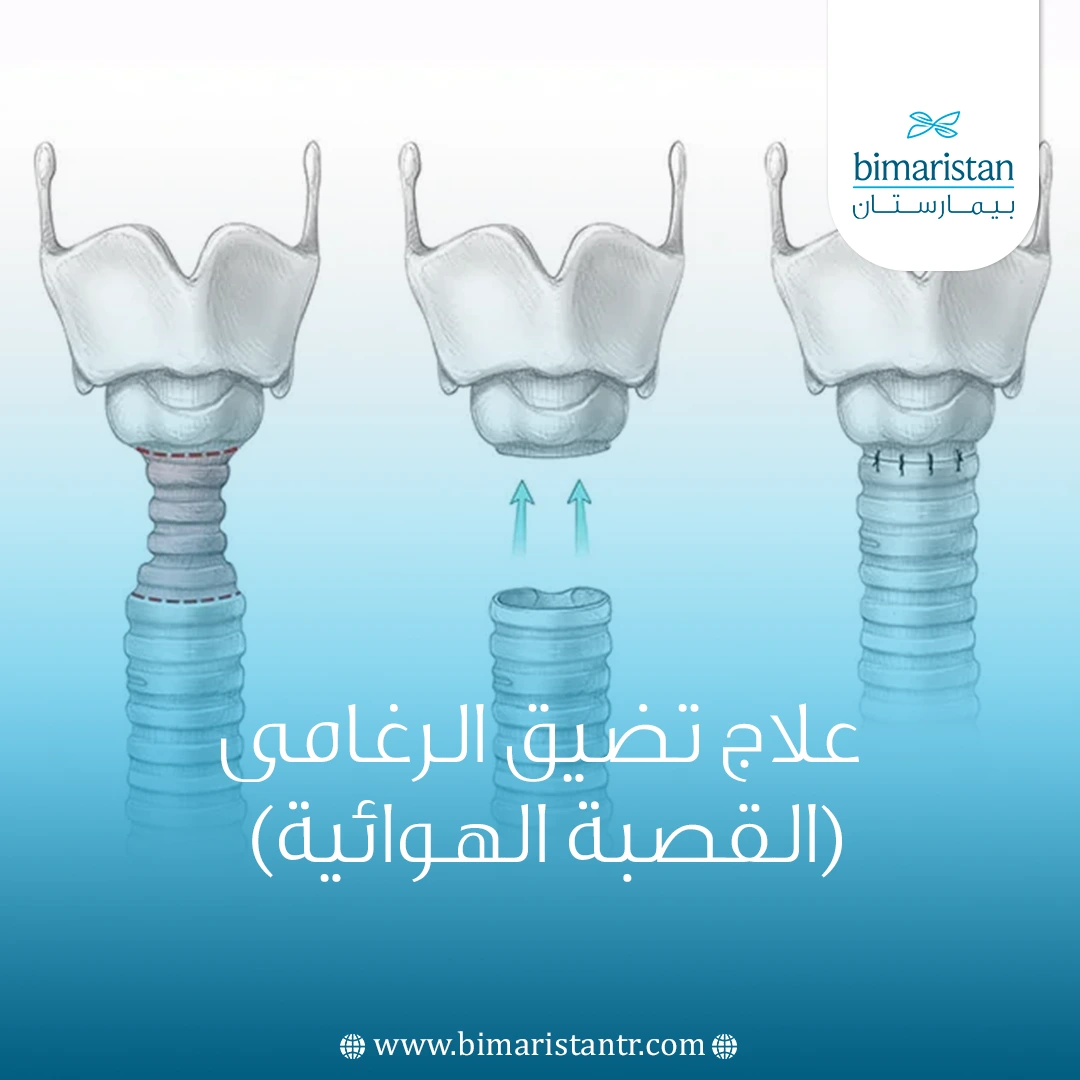 علاج تضيق الرغامى في تركيا