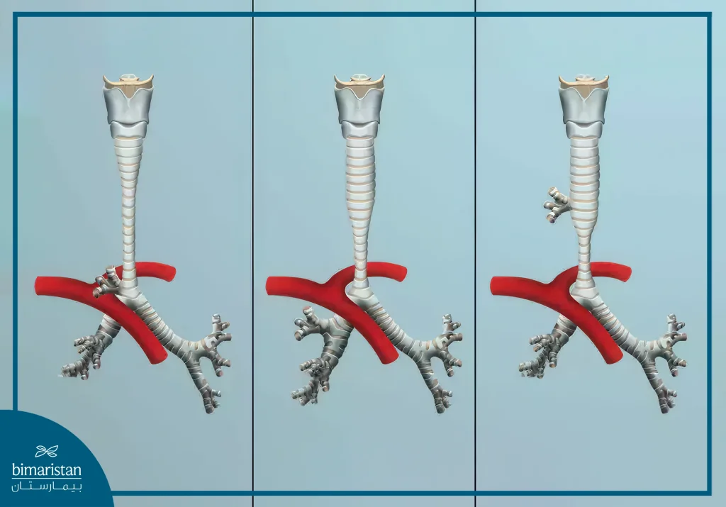 Tracheal Stenosis: Causes, Diagnosis &Amp; Treatment Guide 3 Chatgpt Said:
Tracheal Stenosis: Image Showing The Types According To The Severity Of The Stenosis.
