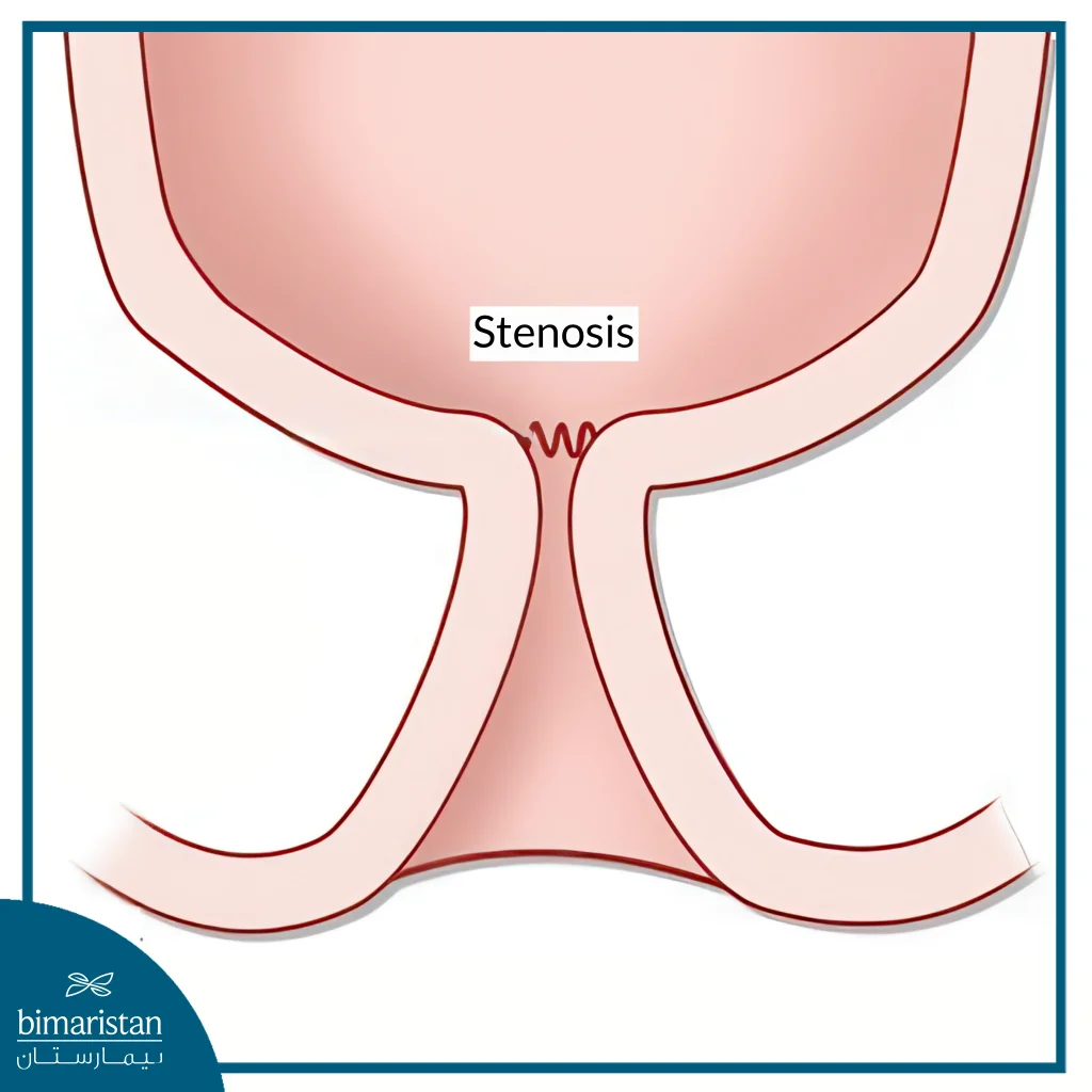 Image Showing Stenosis Of The Anus