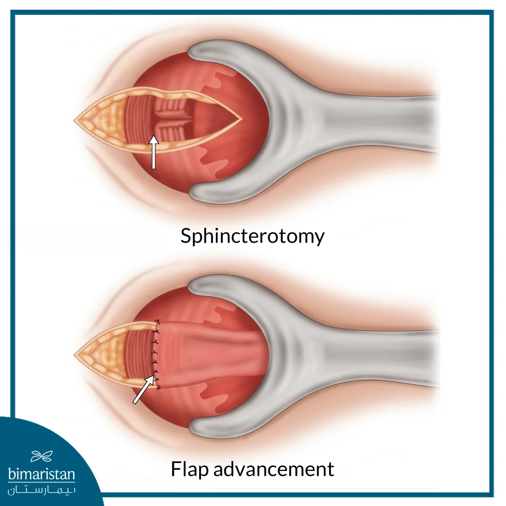 Image Showing Sphincterotomy And Rectal Skin Flap Used In Anal Stenosis Treatment