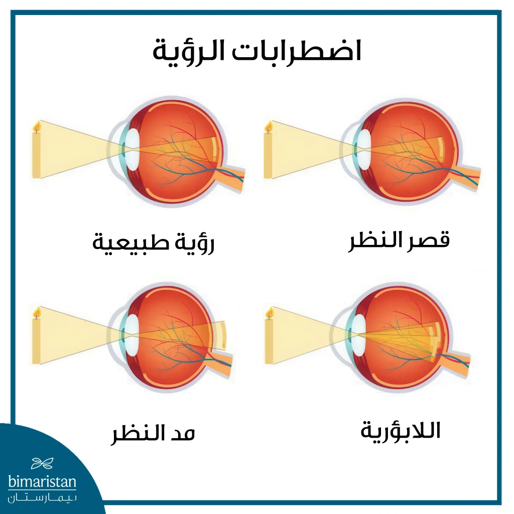عملية آي-ليزك: عملية دقيقة تغيّر حياتك خلال دقائق! 4 صورة توضح العيوب الإنكسارية واضطرابات الرؤية في العين