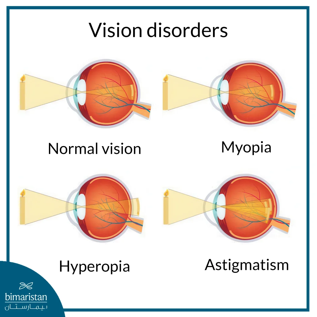 An Image Showing Refractive Errors And Vision Disorders In The Eye