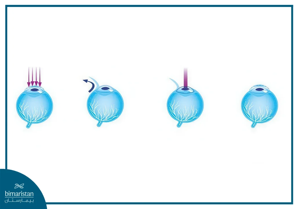 An Image Illustrating The Steps Of I-Lasik Surgery