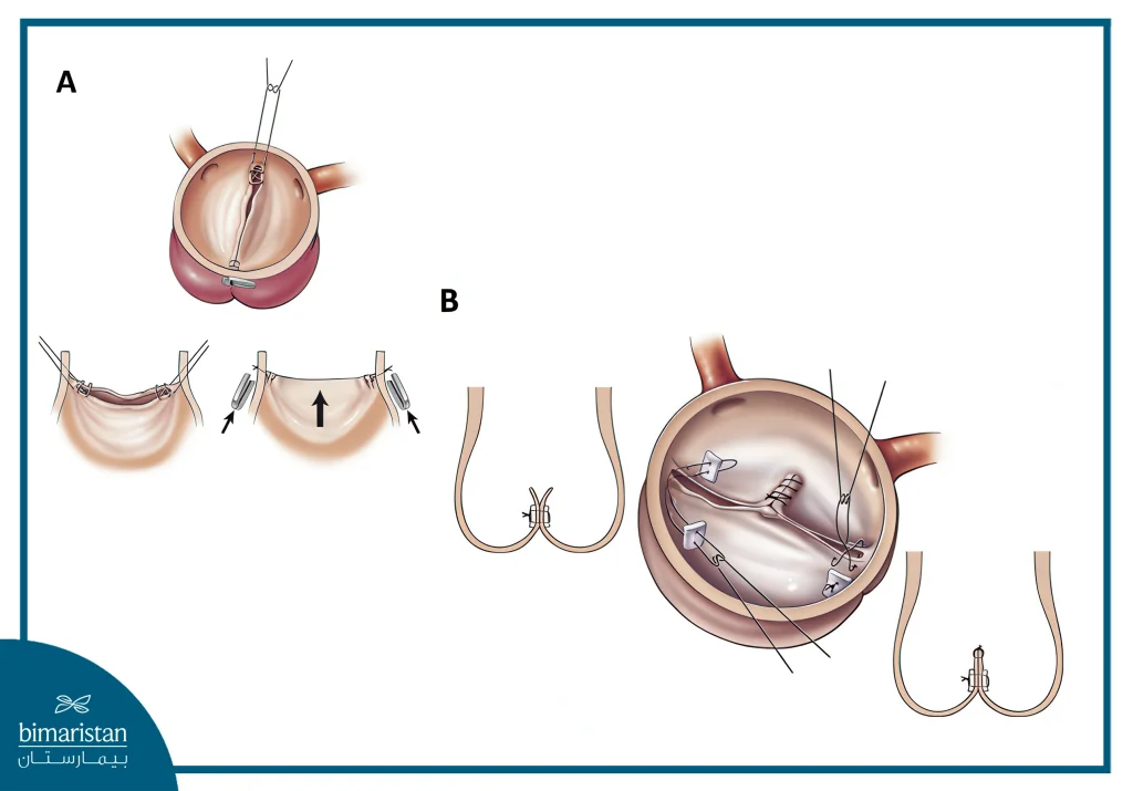 Aortic Valve Repair Surgery: Procedure, Benefits, And Recovery 4 Two Aortic Valve Leaflets Are Joined To Form A Single Leaflet In Aortic Valve Repair Surgery.