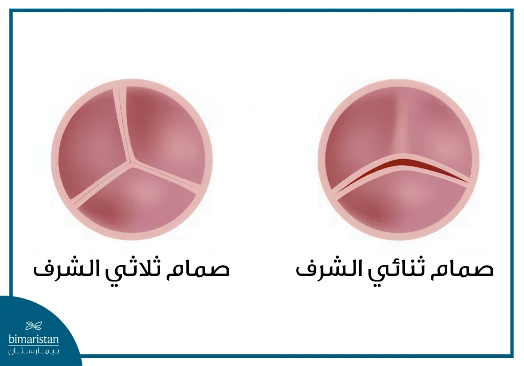 عملية إصلاح الصمام الأبهري 3 يتألف الصمام ثنائي الشرف من وريقتين بينما يتألف الصمام ثلاثي الشرف من ثلاث وريقات