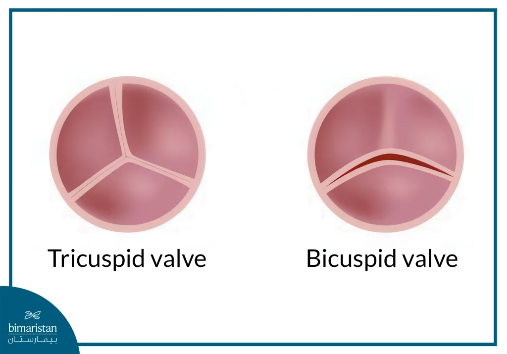 Aortic Valve Repair Surgery: Procedure, Benefits, And Recovery 3 A Bicuspid Valve Consists Of Two Leaflets, While A Tricuspid Valve Consists Of Three Leaflets.