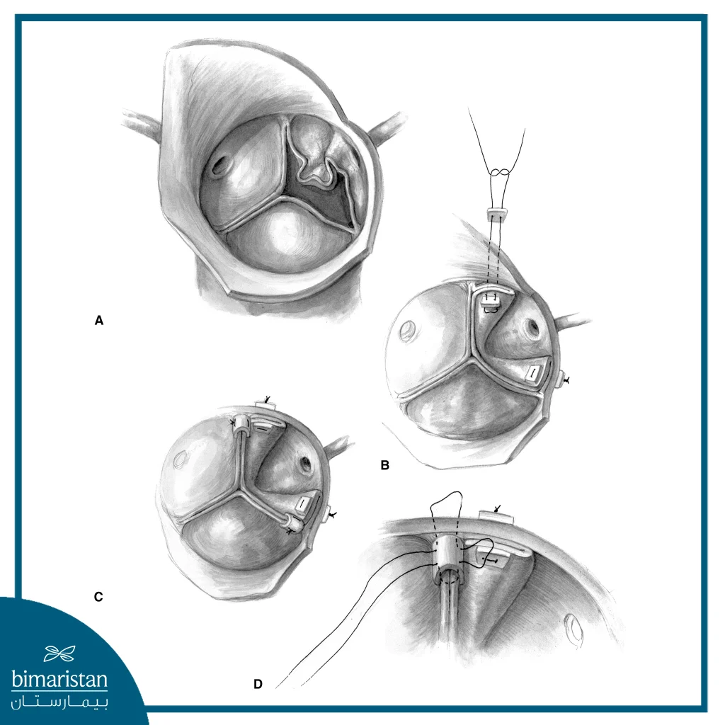 Aortic Valve Repair Surgery: Procedure, Benefits, And Recovery 5 A Tissue Patch Was Placed Over The Tear In Aortic Valve Repair Surgery.
