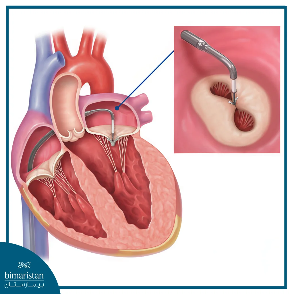 Mitral Valve Repair Surgery: Procedure, Benefits, And Recovery 6 Image Showing How To Place The Mitraclip.