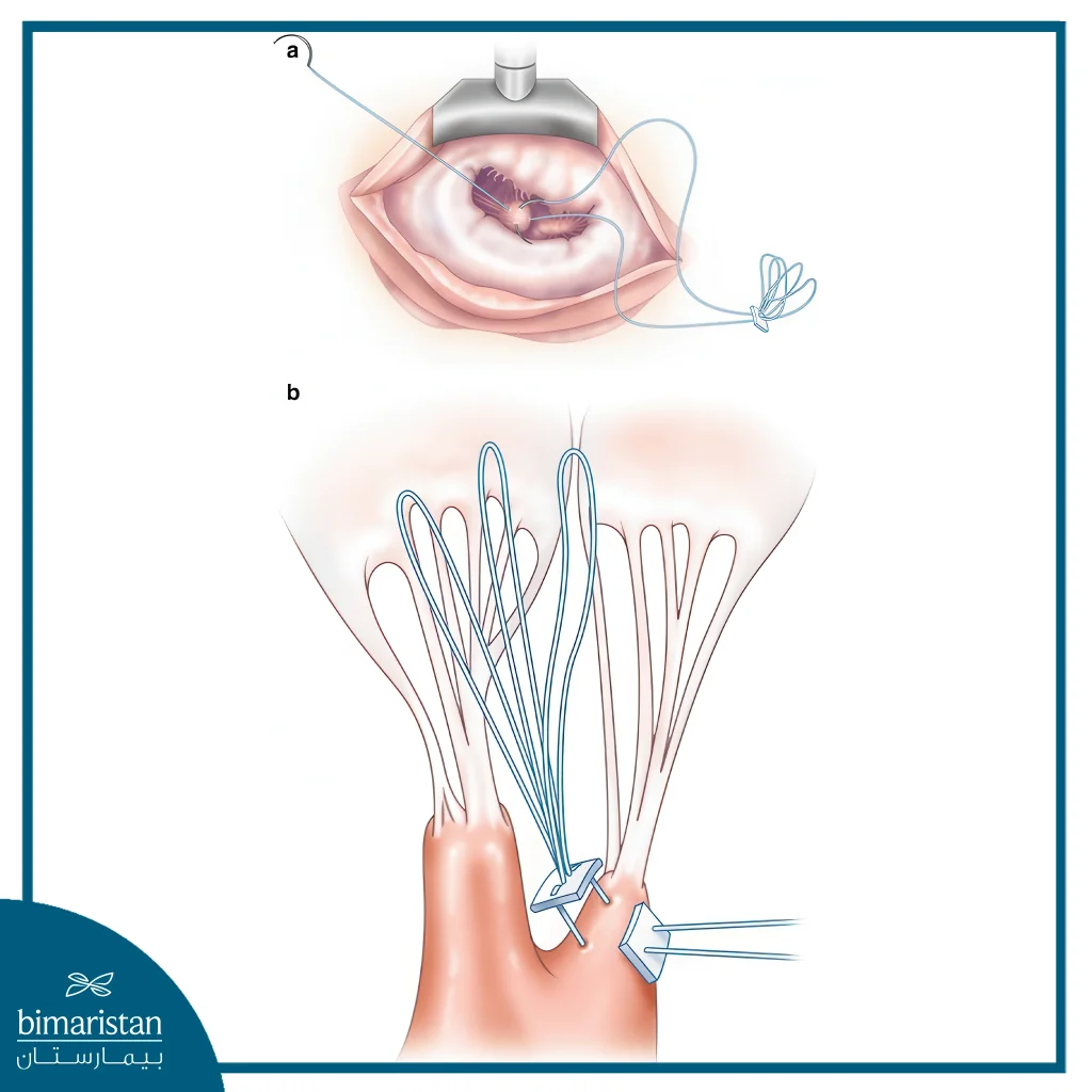 Mitral Valve Repair Surgery: Procedure, Benefits, And Recovery 5 Image Showing How The Strings Are Replaced With Artificial Ones In Mitral Valve Repair Surgery In Turkey.