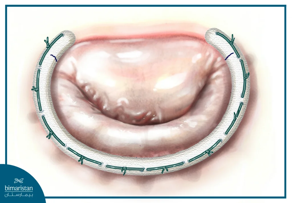 Mitral Valve Repair Surgery: Procedure, Benefits, And Recovery 3 The Mitral Valve Repair Was Performed Using An Incomplete Annulus To Reinforce The Mitral Valve'S Attachment Site.