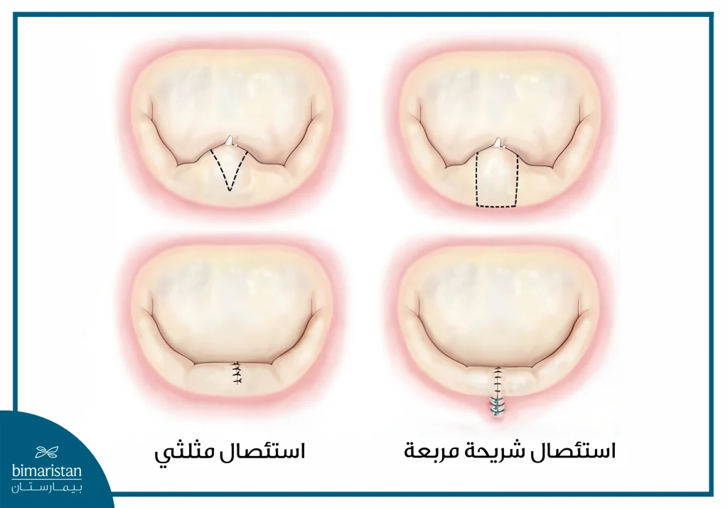 عملية إصلاح الصمام التاجي 4 لاحظ عدم وصول حواف الاستئصال إلى حلقة الصمام في الاستئصال المثلثي بينما يتم استئصال جزء من حلقة الصمام عند استئصال شريحة مربعة