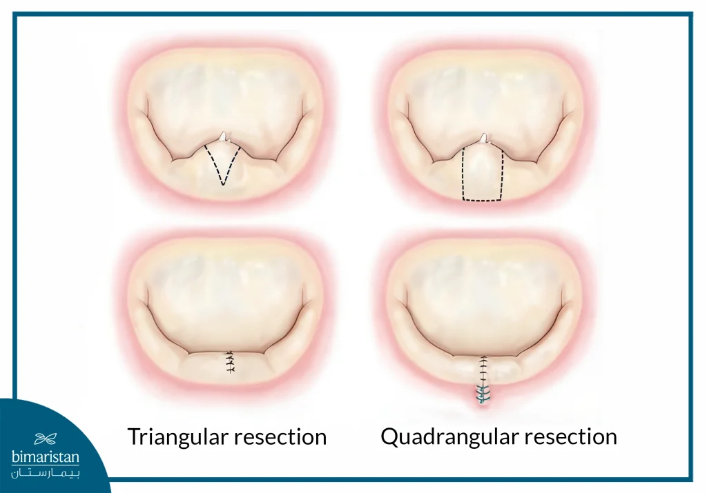 Mitral Valve Repair Surgery: Procedure, Benefits, And Recovery 4 Note That The Resection Edges Do Not Reach The Valve Annulus In Triangular Segment Resection, Whereas A Portion Of The Valve Annulus Is Resected In Square Segment Resection.