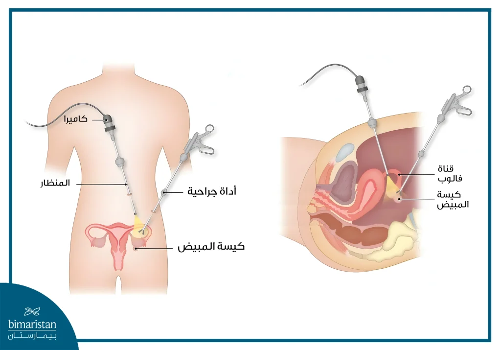 عملية استئصال المبيض بالمنظار 3 إدخال المنظار والأدوات الجراحية في عملية استئصال المبيض بالمنظار