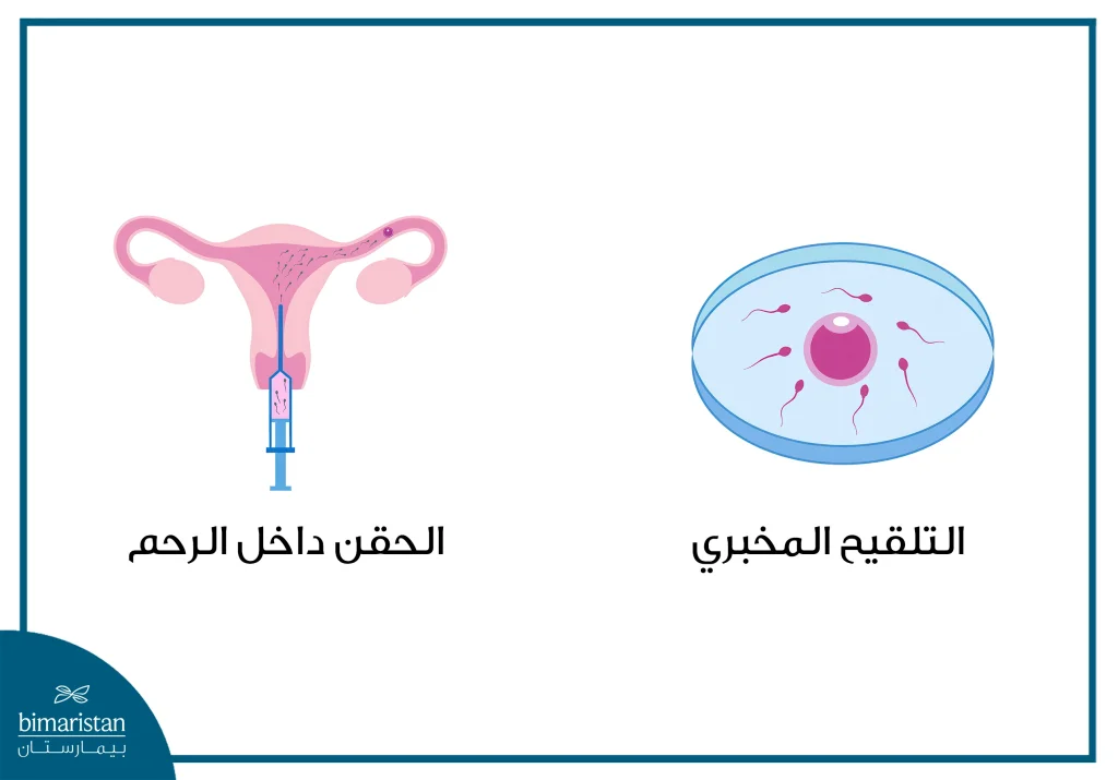 عملية التلقيح الاصطناعي لعلاج العقم 4 مقارنة بسيطة بين الحقن داخل الرحم وعملية أطفال الأنابيب التي تجرى في تركيا