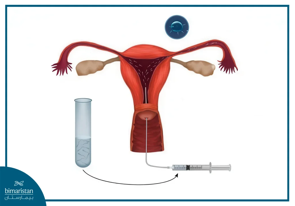 Iui In Turkey: Intrauterine Insemination Procedure &Amp; Success Rates 2 Intrauterine Insemination (Iui) Is One Of The First Options That Couples Suffering From Infertility Resort To.