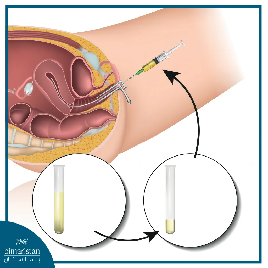 Iui In Turkey: Intrauterine Insemination Procedure &Amp; Success Rates 3 The Image Shows The Injection Of A Man’s Sperm Into The Uterus Using A Special Needle. These Methods Are Considered Iui Methods, As The Iui Process Is Used To Treat Infertility In Couples.
