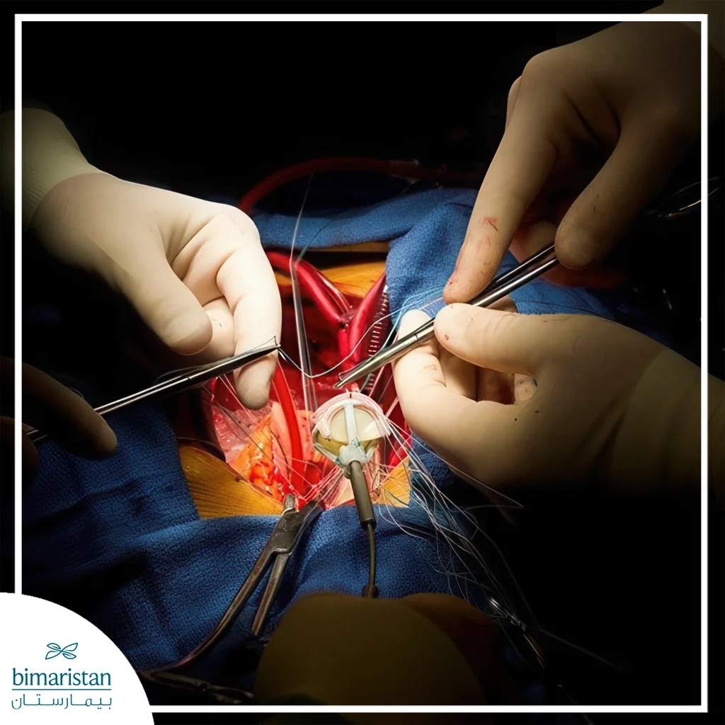 Minimally Invasive Aortic Valve Replacement: Procedure, Benefits, And Recovery 3 Minimally Invasive Aortic Valve Replacement