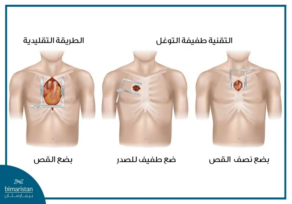 عملية تبديل الصمام الأبهري طفيفة التوغل 4 يمكن إجراء عملية تبديل الصمام الأبهري بالطريقة التقليدية عبر بضع القص أو بواسطة تقنيات أخرى طفيفة التوغل