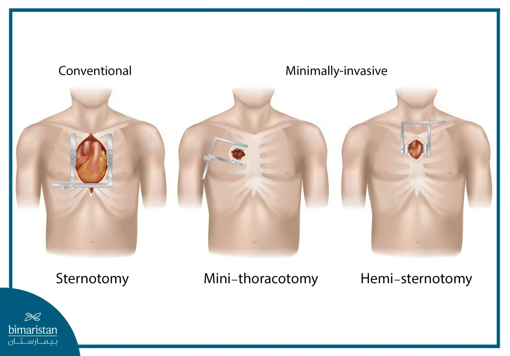 Minimally Invasive Aortic Valve Replacement: Procedure, Benefits, And Recovery 4 Aortic Valve Replacement Can Be Performed Traditionally Via Sternotomy Or By Other Minimally Invasive Techniques.