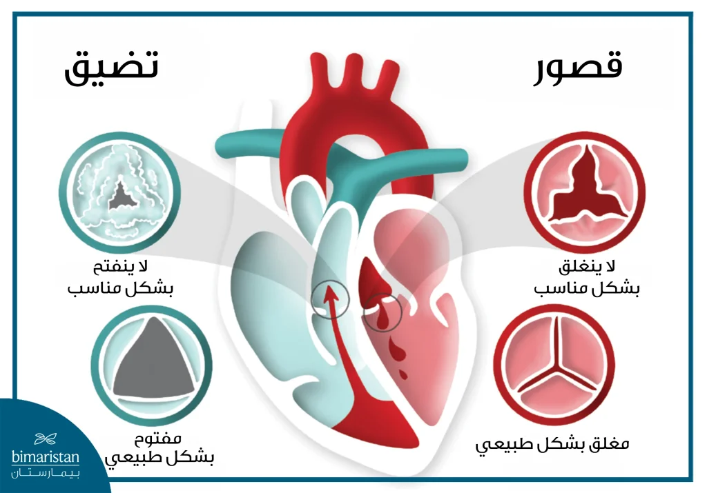عملية تبديل الصمام الأبهري 3 في حالة قصور الصمام فإن الصمام لا يغلق بشكل جيد بينما في حالة تضيق الصمام فإن الصمام لا يفتح بشكل جيد