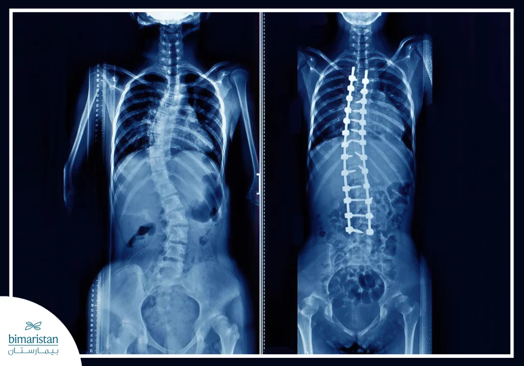 عملية دمج الفقرات لعلاج الانزلاق الغضروفي والعمود الفقري: متى تُجرى وما فوائدها؟ 3 عملية تثبيت الفقرات مع الدعامات المعدنية