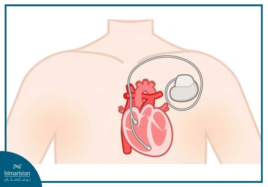 Pacemaker Implantation Surgery: Everything You Need To Know 4 In Pacemaker Implantation Surgery, A Pacemaker Consists Of An Impulse Generator In A Small Metal Case And Leads That Are Directed Through Veins Into The Chambers Of The Heart.