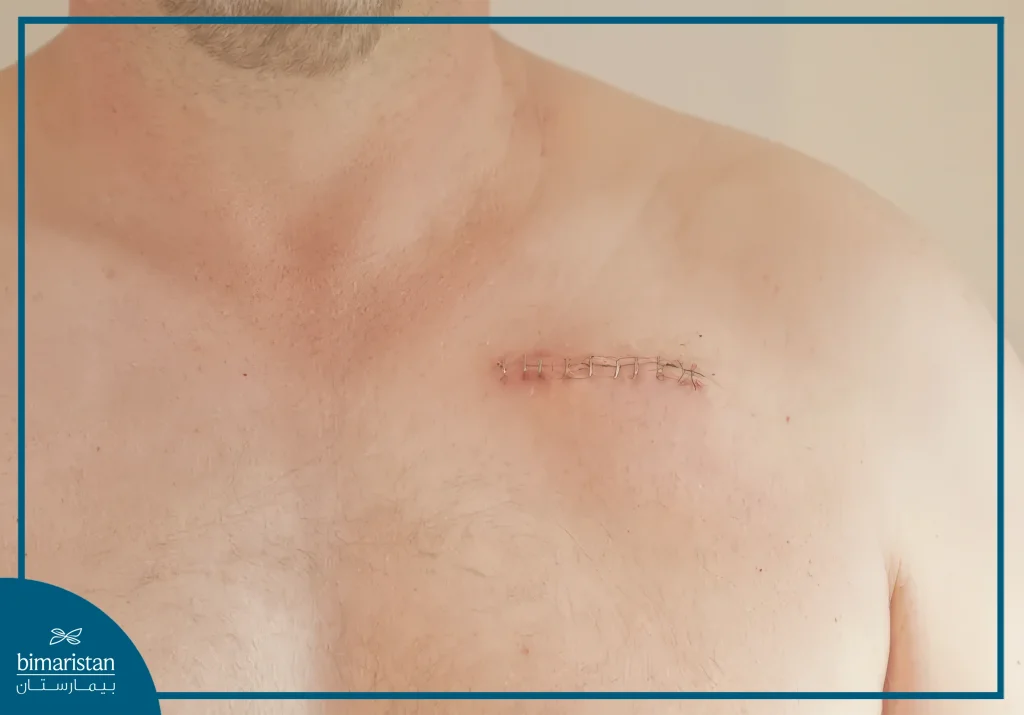 Pacemaker Implantation Surgery: Everything You Need To Know 5 A Small Horizontal Surgical Incision Near The Collarbone On The Left Side Of The Chest