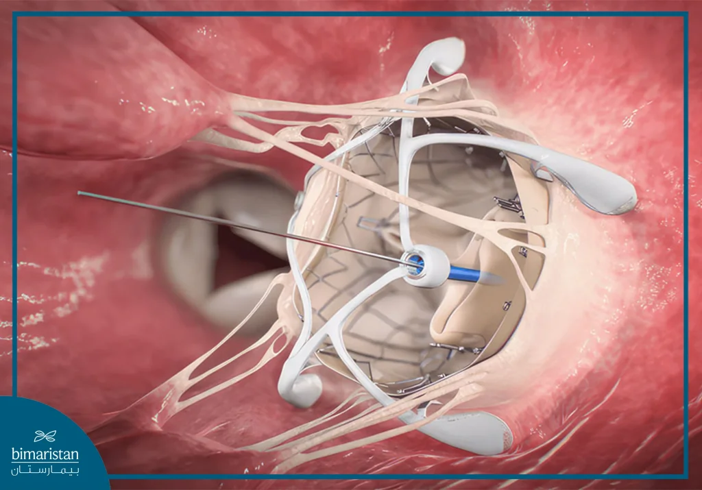 Mitral Valve Replacement Surgery In Turkey: Procedure &Amp; Recovery 4 Image Showing The Scope And Catheter Used During Mitral Valve Replacement Surgery, With A View Of An Artificial Valve Being Placed At The Site Of The Damaged Valve.