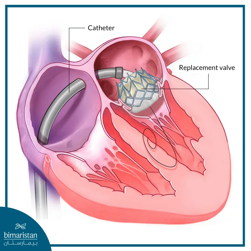 Mitral Valve Replacement Surgery In Turkey: Procedure &Amp; Recovery 5 Illustration Showing A Catheter Inserted Into The Left Atrium During Mitral Valve Replacement Surgery To Place A New Artificial Valve In Place Of The Damaged Mitral Valve.
