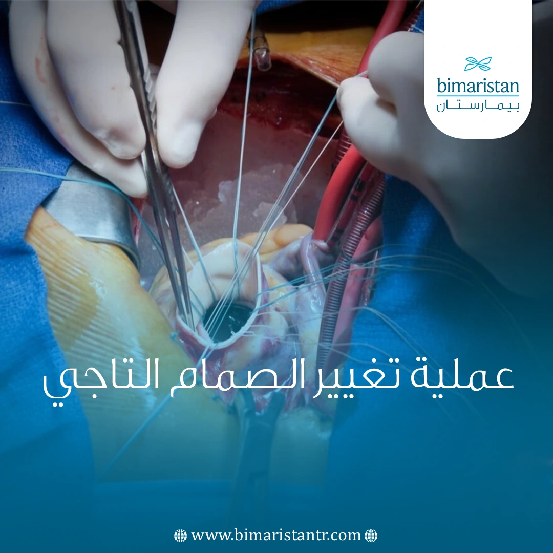 عملية تغيير الصمام التاجي في تركيا