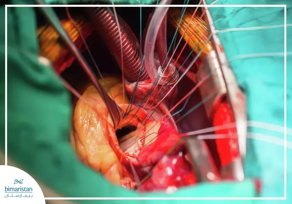 Heart Valve Replacement Surgery: Types, Procedure, And Recovery Guide 8 A Photo Taken During A Heart Valve Replacement Surgery In Turkey.