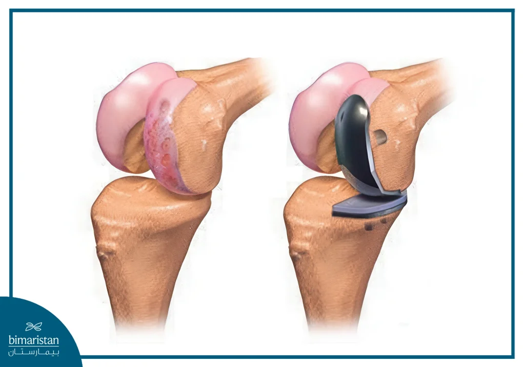 Partial Knee Replacement Surgery 5 The Result Of Partial Knee Replacement Surgery And The Difference Between Before And After The Operation
