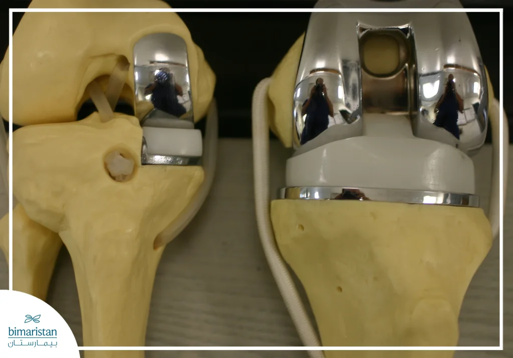 Partial Knee Replacement Surgery 6 Comparison Between The Artificial Joint Used In Total Knee Replacement Surgery And Partial Knee Replacement Surgery