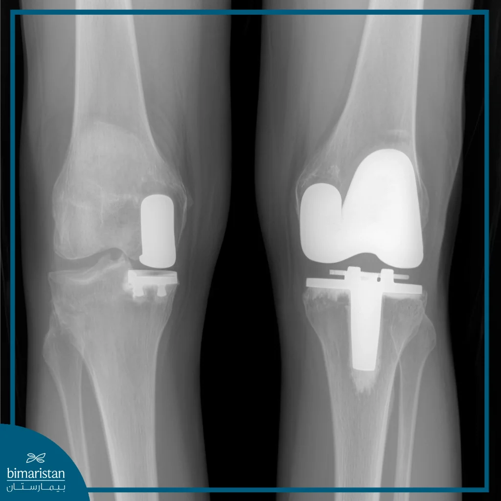 Partial Knee Replacement Surgery 4 X-Ray Images Comparing A Partial Knee Replacement With A Total Knee Replacement.