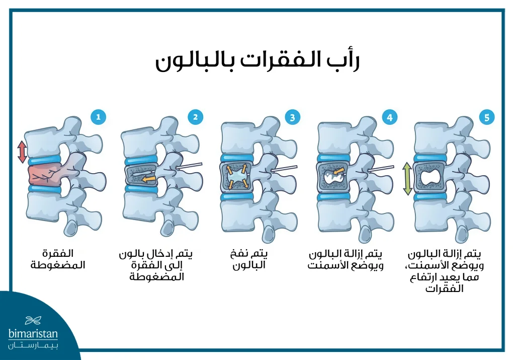 عملية رأب الفقرات بالبالون: علاج بلا جراحة 4 طريقة إجراء عملية رأب الفقرات بالبالون