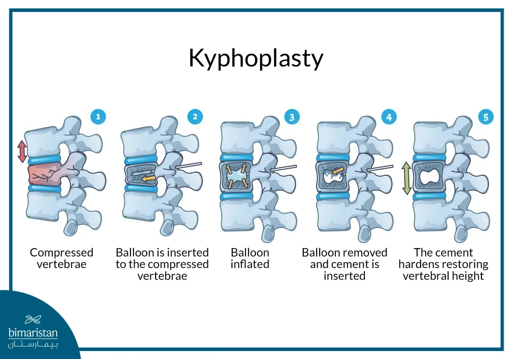 Balloon Kyphoplasty: Minimally Invasive Treatment For Spinal Fractures 5 Balloon Kyphoplasty Procedure