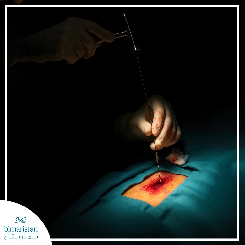 Balloon Kyphoplasty: Minimally Invasive Treatment For Spinal Fractures 4 The Patient Is In The Supine Position On The Abdomen, And The Trocar Needle Is Inserted During Balloon Kyphoplasty